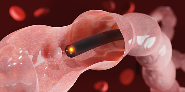 Demystifying Colonoscopy: An Introductory Overview