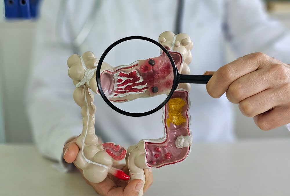 Colorectal Cancer Awareness Month: Screening Saves Lives